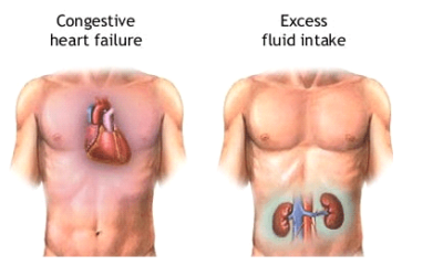 ARTERIES BLOCKAGE CURED WITHOUT BYPASS SURGERY (80% GOOD RESULTS)